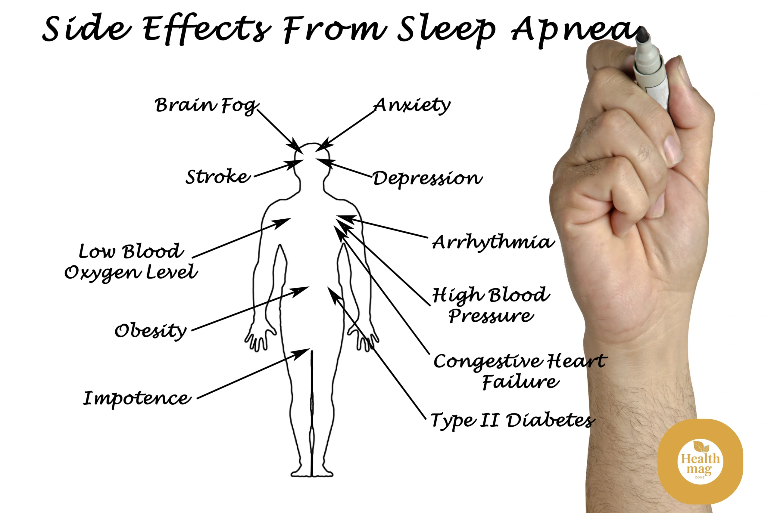 What Are the Side Effects of Extreme Sleep Apnea?