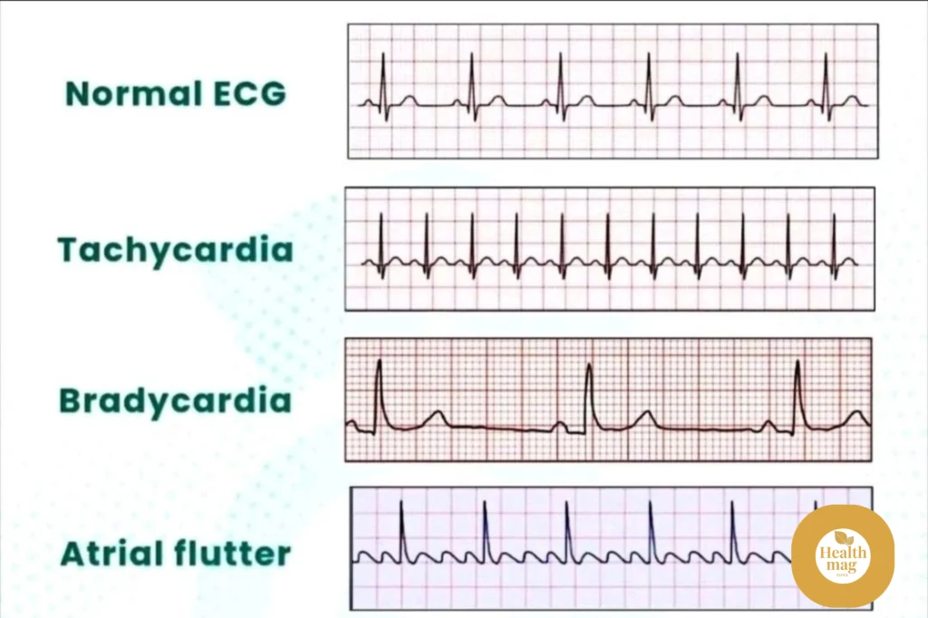 How Does an EKG Assist in Diagnosing a Heart Attack?